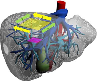 All the Routes for Laparoscopic Liver Segment VIII Resection: A Comprehensive Review of Surgical Techniques